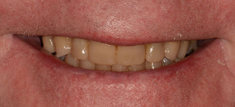After Repairing Severely Worn Teeth