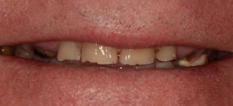 Before Repairing Severely Worn Teeth