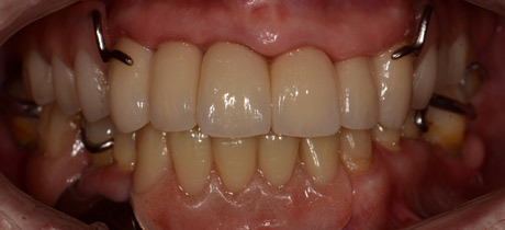 After Repairing Advanced Acid Erosion and Missing Tooth