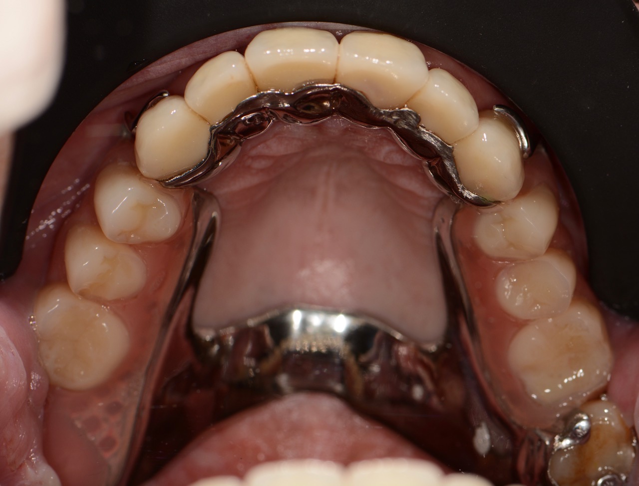 After Repairing Advanced Acid Erosion and Missing Tooth