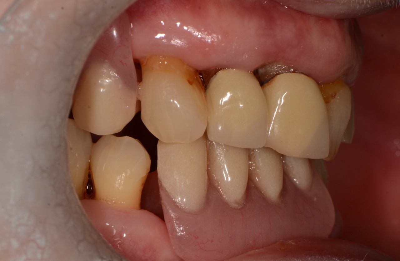 Before Repairing Advanced Acid Erosion and Missing Tooth