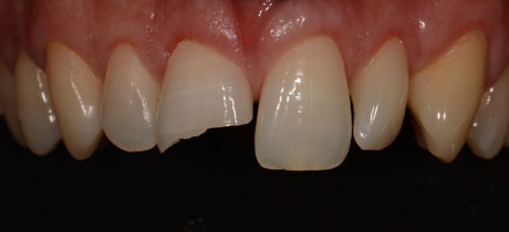 Before broken Tooth repair