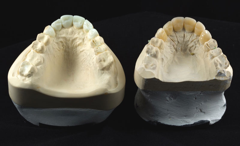 Teeth Model of Patient