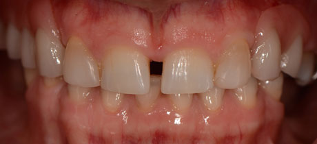 teeth translucent edges