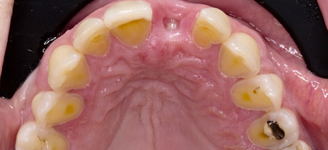 Before Repairing Advanced Acid Erosion and Missing Tooth