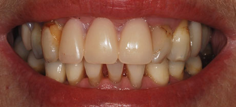 Before Complete Smile Makeover